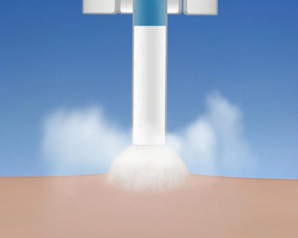 Cryotherapy Frysebehandling