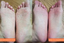 Exfoliation Foot Peel