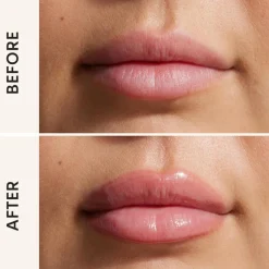 Lip Filler