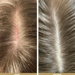 Sampak Skæl og Tør Hovedbund