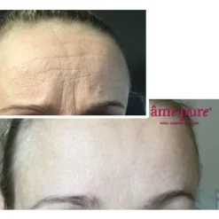 WrinkleEraser Basic Kit