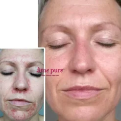 WrinkleEraser Basic Kit